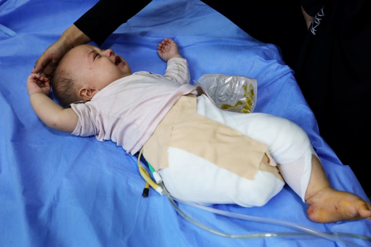 Gazan infant loses leg in Israeli airstrike
